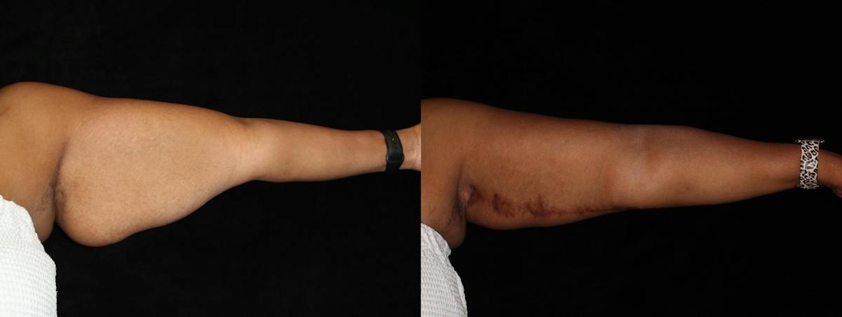 Arm Lift Before & After Gallery - Patient 369958 - Image 2