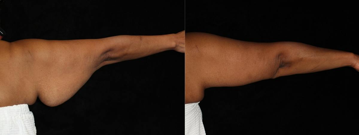Arm Lift Before & After Gallery - Patient 369958 - Image 3