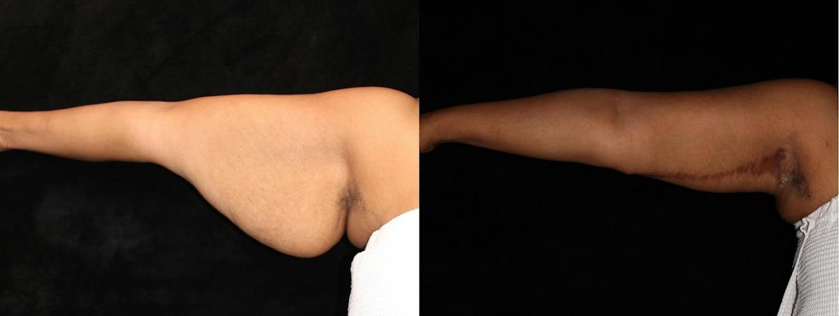 Arm Lift Before & After Gallery - Patient 369958 - Image 1