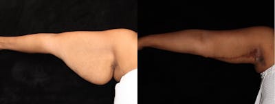Arm Lift Before & After Gallery - Patient 369958 - Image 1
