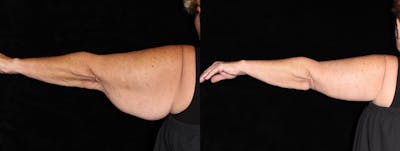 Arm Lift Before & After Gallery - Patient 667939 - Image 1