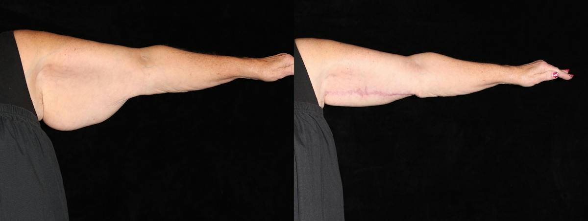 Arm Lift Before & After Gallery - Patient 667939 - Image 3