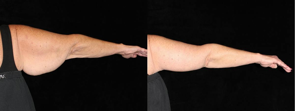 Arm Lift Before & After Gallery - Patient 667939 - Image 2