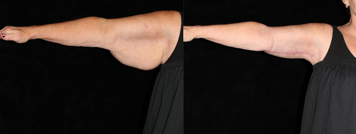 Arm Lift Before & After Gallery - Patient 667939 - Image 4