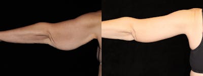 Arm Lift Before & After Gallery - Patient 335438 - Image 1