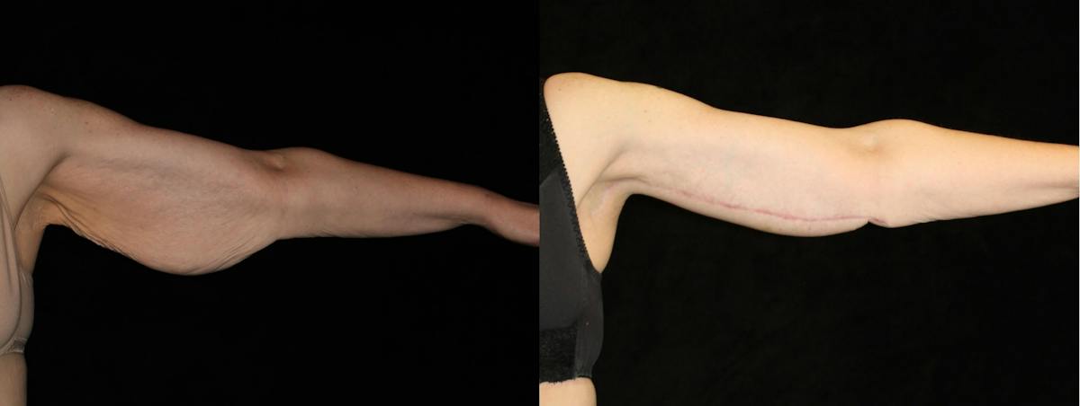 Arm Lift Before & After Gallery - Patient 335438 - Image 4
