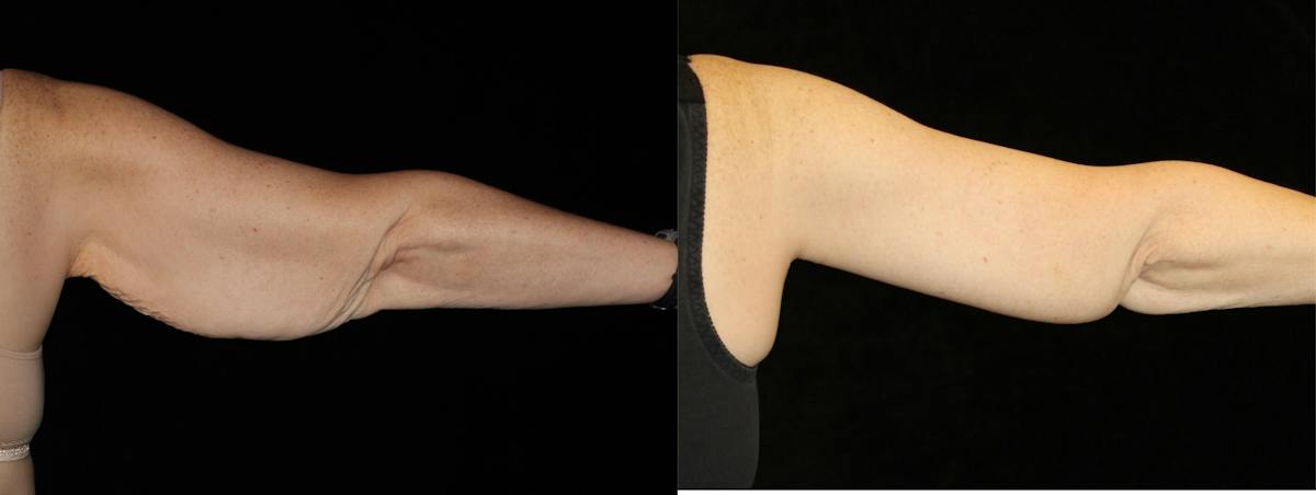 Arm Lift Before & After Gallery - Patient 335438 - Image 2