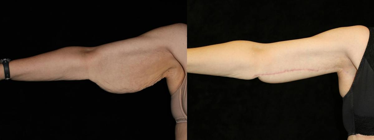 Arm Lift Before & After Gallery - Patient 335438 - Image 3