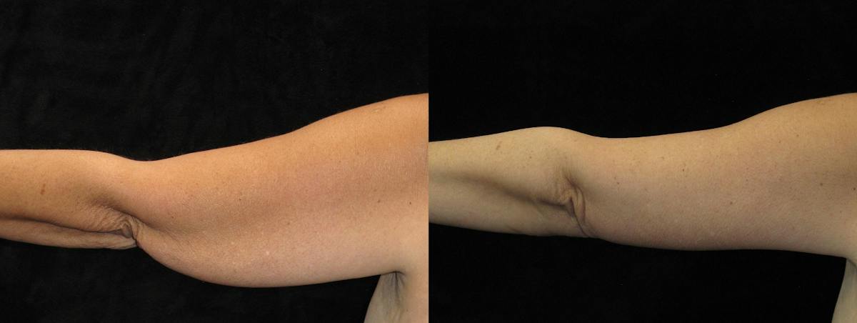 Arm Lift Before & After Gallery - Patient 341795 - Image 1