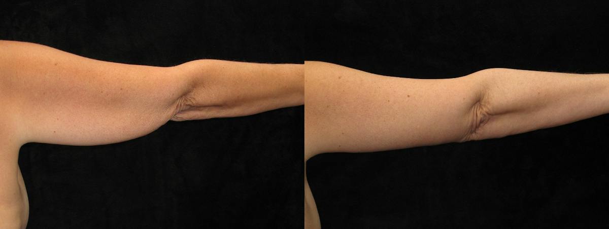 Arm Lift Before & After Gallery - Patient 341795 - Image 2