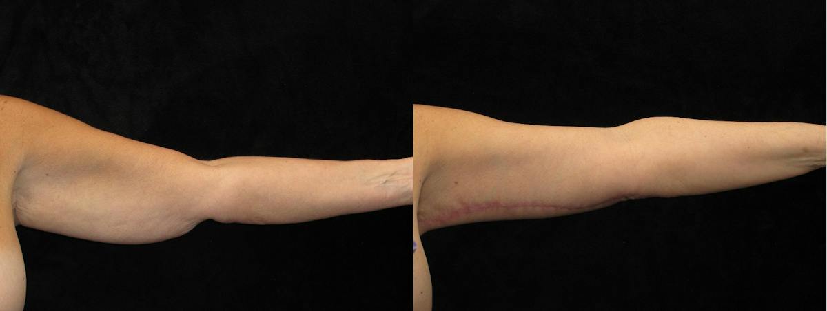 Arm Lift Before & After Gallery - Patient 341795 - Image 4