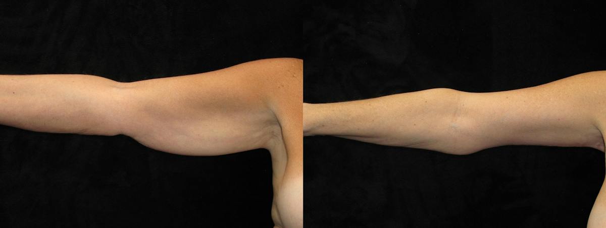 Arm Lift Before & After Gallery - Patient 341795 - Image 3