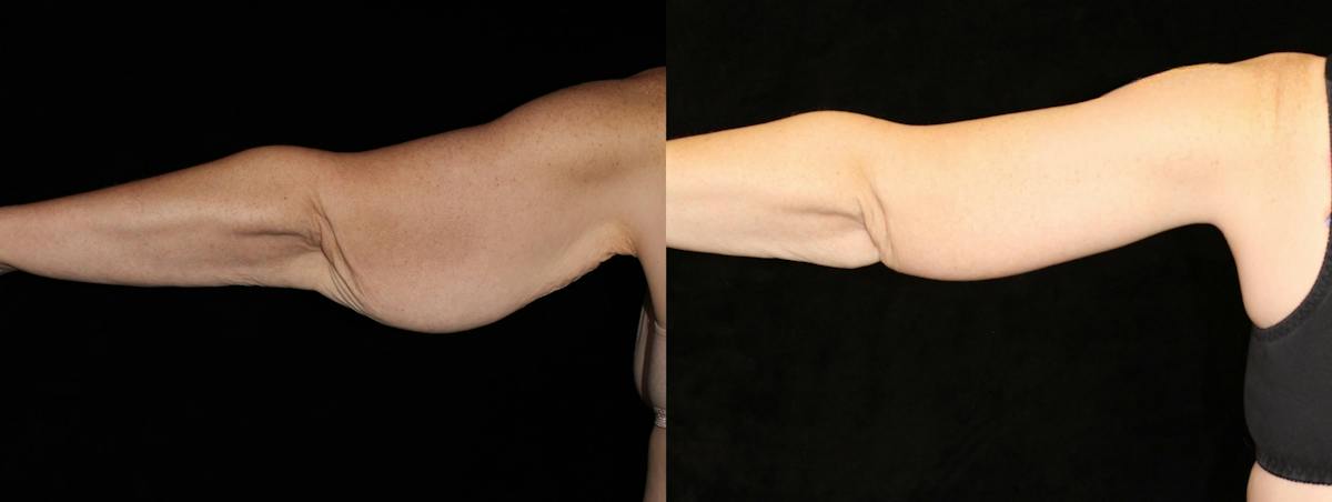 Arm Lift Before & After Gallery - Patient 842588 - Image 1