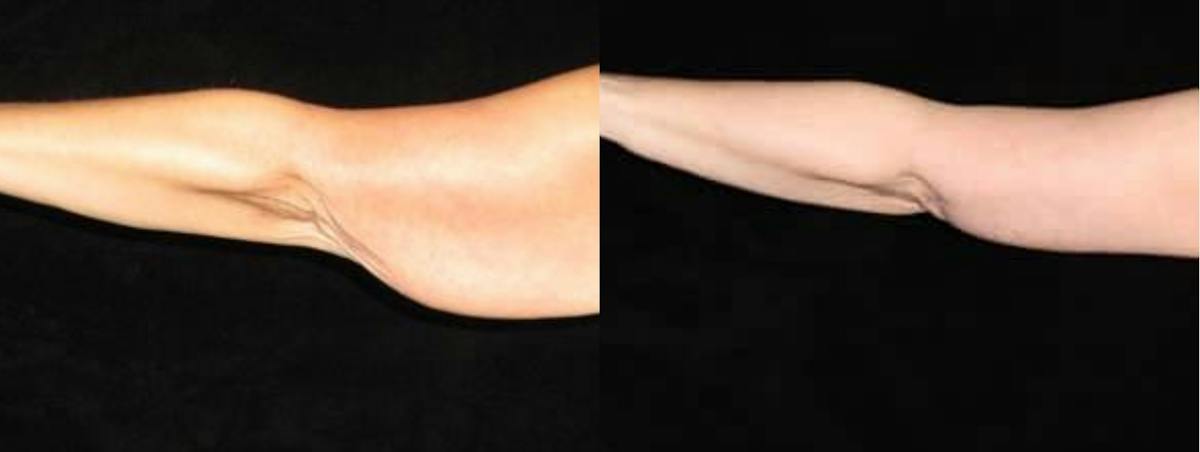 Arm Lift Before & After Gallery - Patient 842588 - Image 3