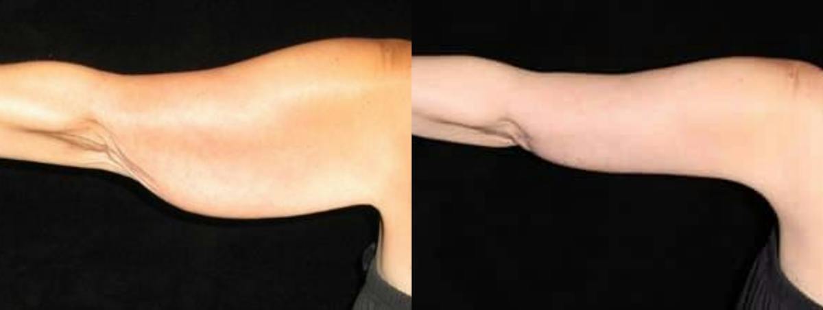 Arm Lift Before & After Gallery - Patient 842588 - Image 4