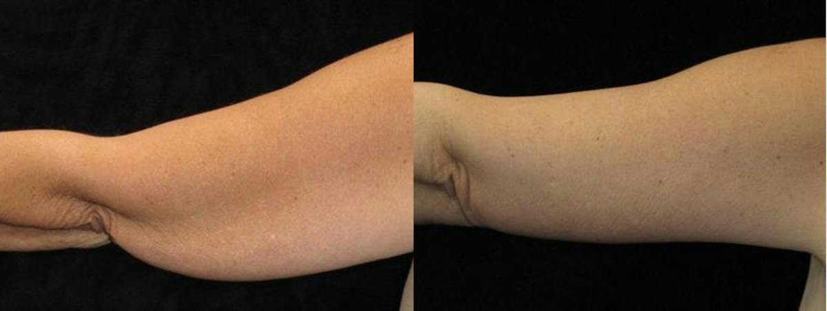 Arm Lift Before & After Gallery - Patient 362825 - Image 1