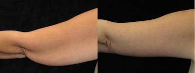 Arm Lift Before & After Gallery - Patient 362825 - Image 1