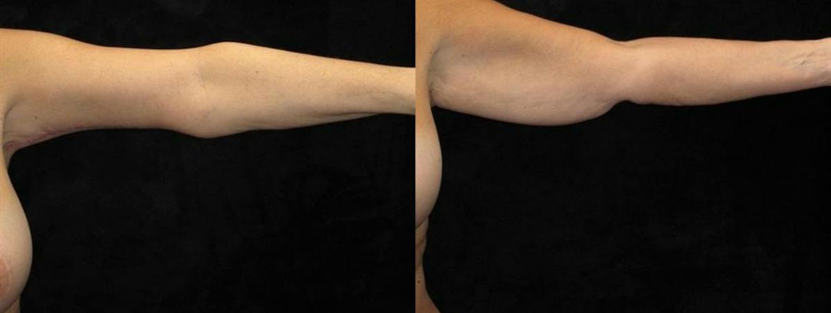 Arm Lift Before & After Gallery - Patient 362825 - Image 2