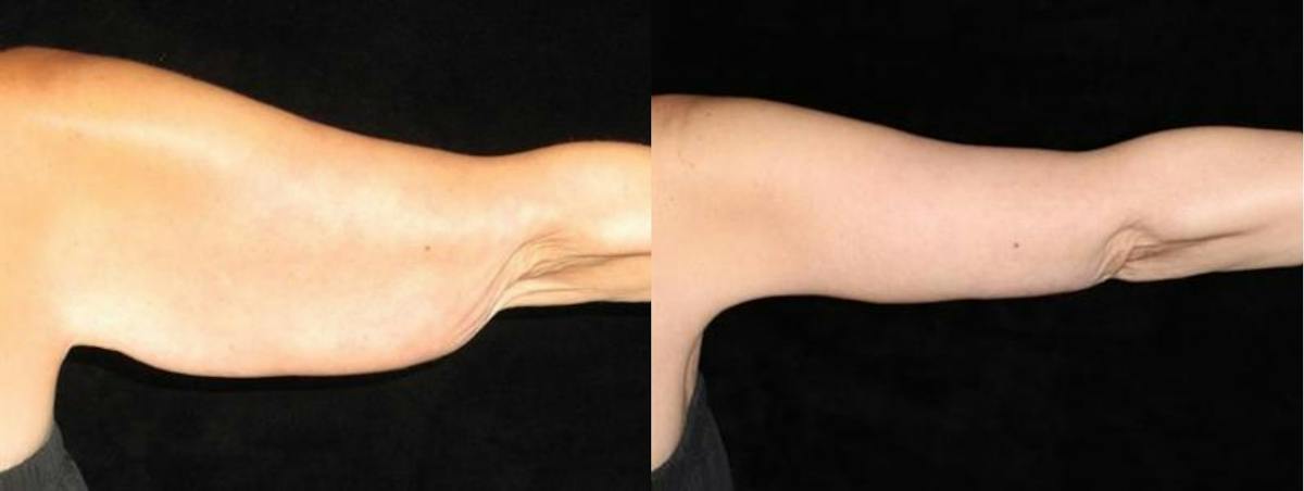 Arm Lift Before & After Gallery - Patient 591772 - Image 1
