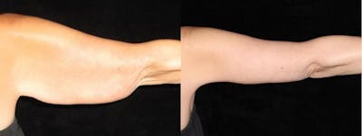 Arm Lift Before & After Gallery - Patient 591772 - Image 1