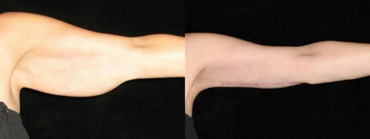 Arm Lift Before & After Gallery - Patient 591772 - Image 2