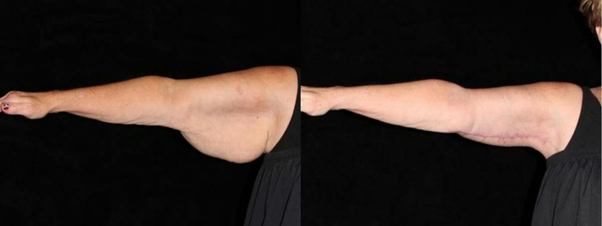 Arm Lift Before & After Gallery - Patient 594501 - Image 1