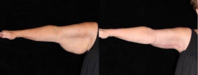 Arm Lift Before & After Gallery - Patient 594501 - Image 1