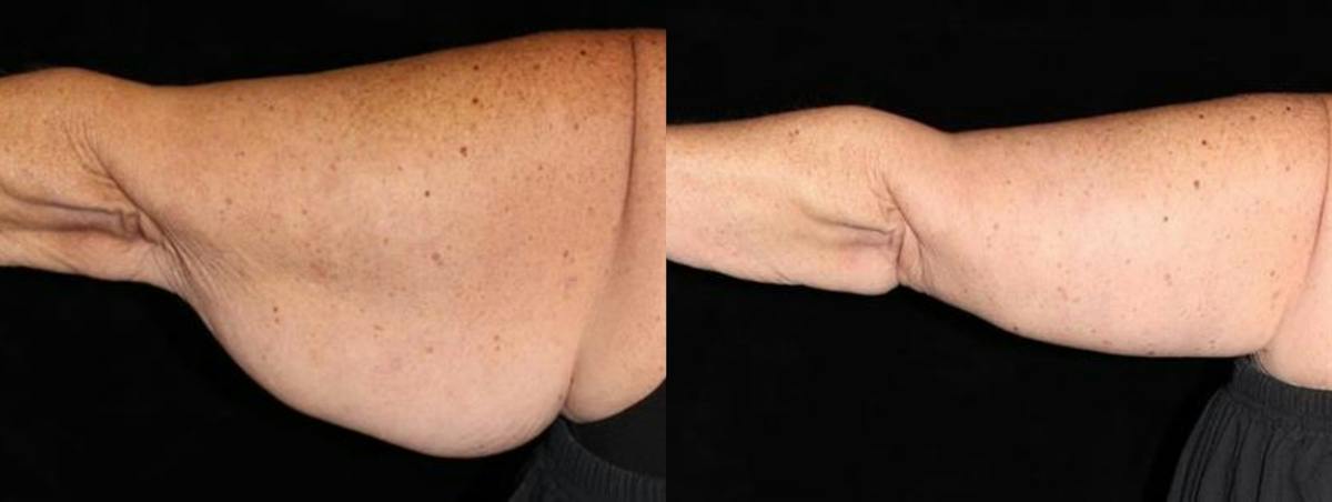 Arm Lift Before & After Gallery - Patient 594501 - Image 2