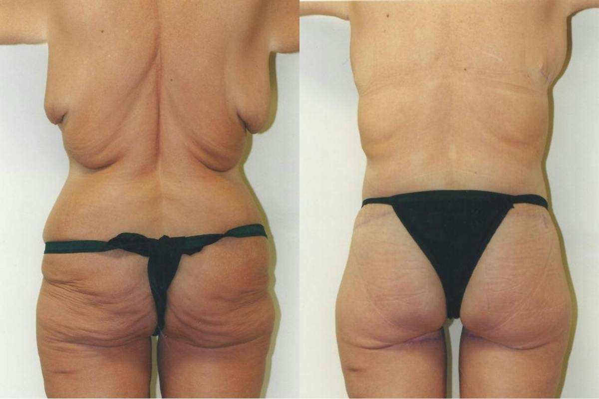 Body Lift Before & After Gallery - Patient 734823 - Image 2