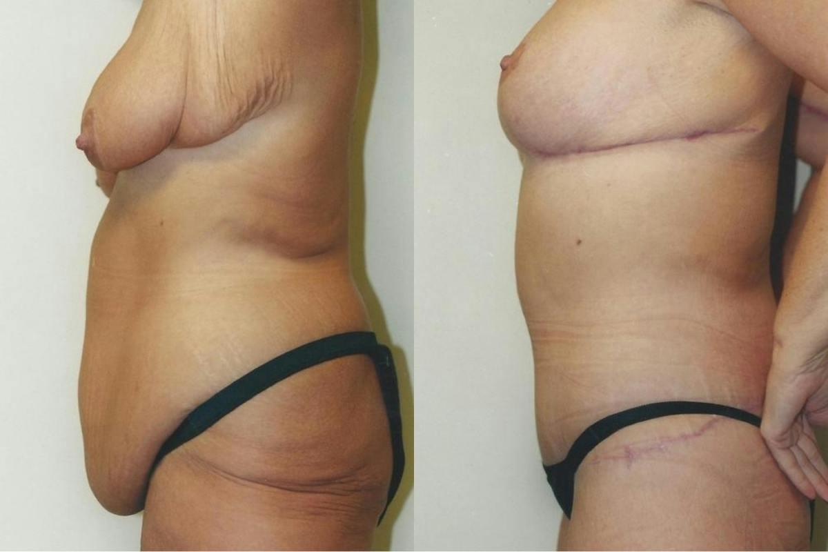 Body Lift Before & After Gallery - Patient 734823 - Image 1