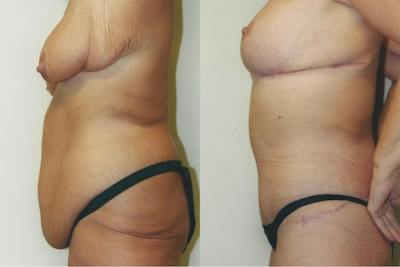 Body Lift Before & After Gallery - Patient 734823 - Image 1