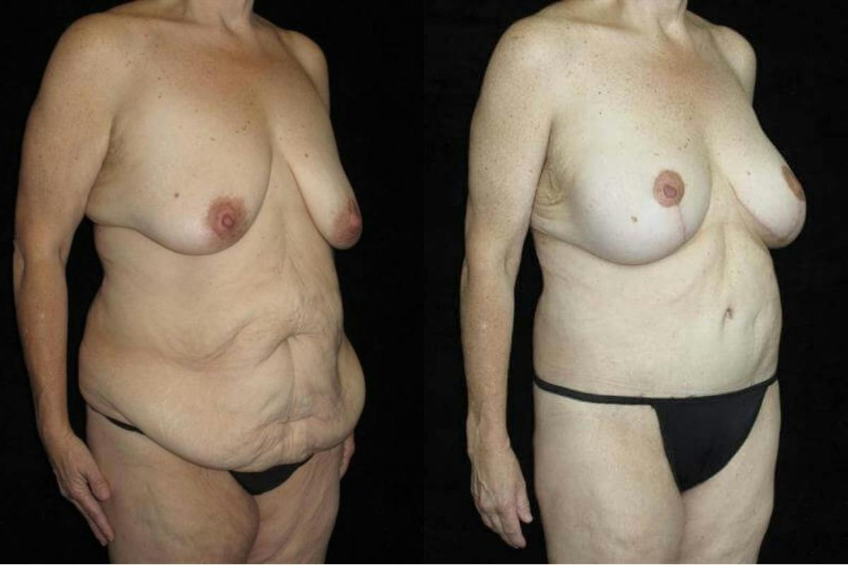 Body Lift Before & After Gallery - Patient 178483 - Image 2