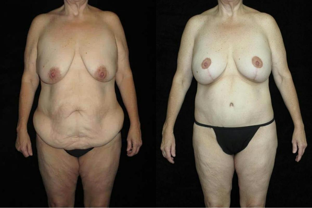 Body Lift Before & After Gallery - Patient 178483 - Image 1