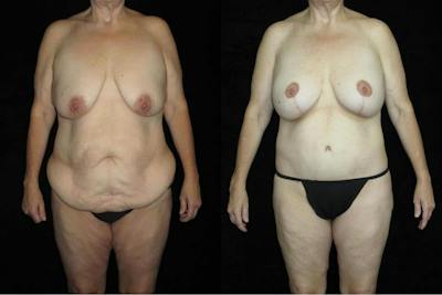 Body Lift Before & After Gallery - Patient 178483 - Image 1