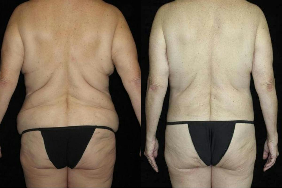 Body Lift Before & After Gallery - Patient 178483 - Image 4