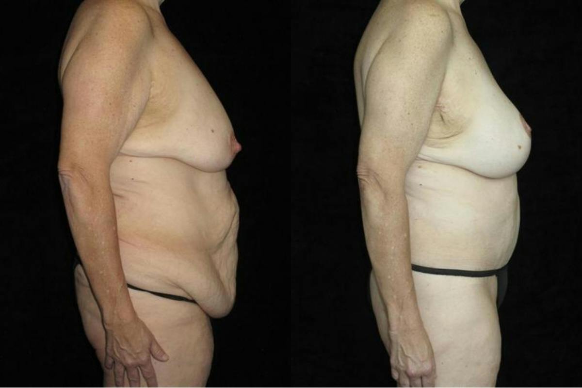Body Lift Before & After Gallery - Patient 178483 - Image 3