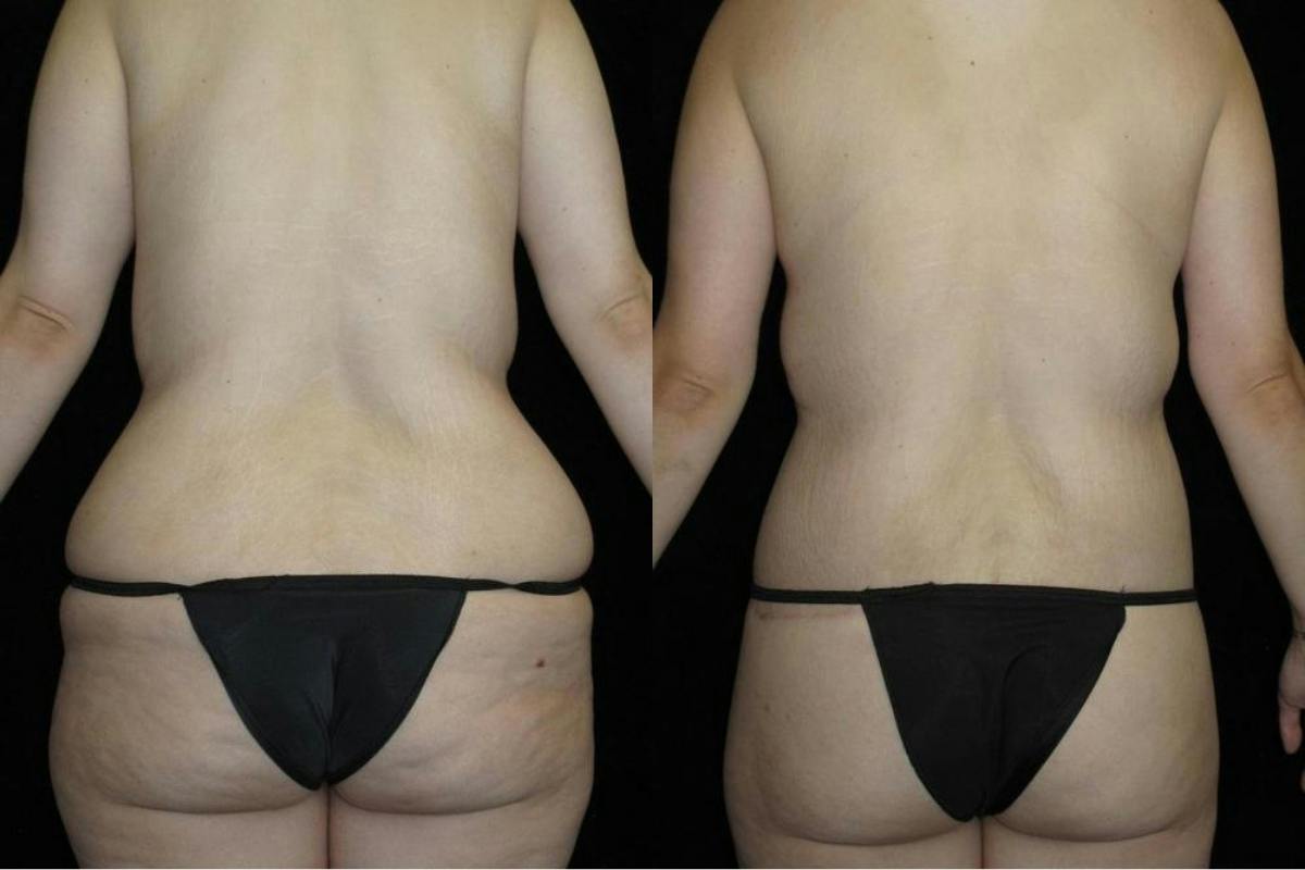 Body Lift Before & After Gallery - Patient 956537 - Image 2