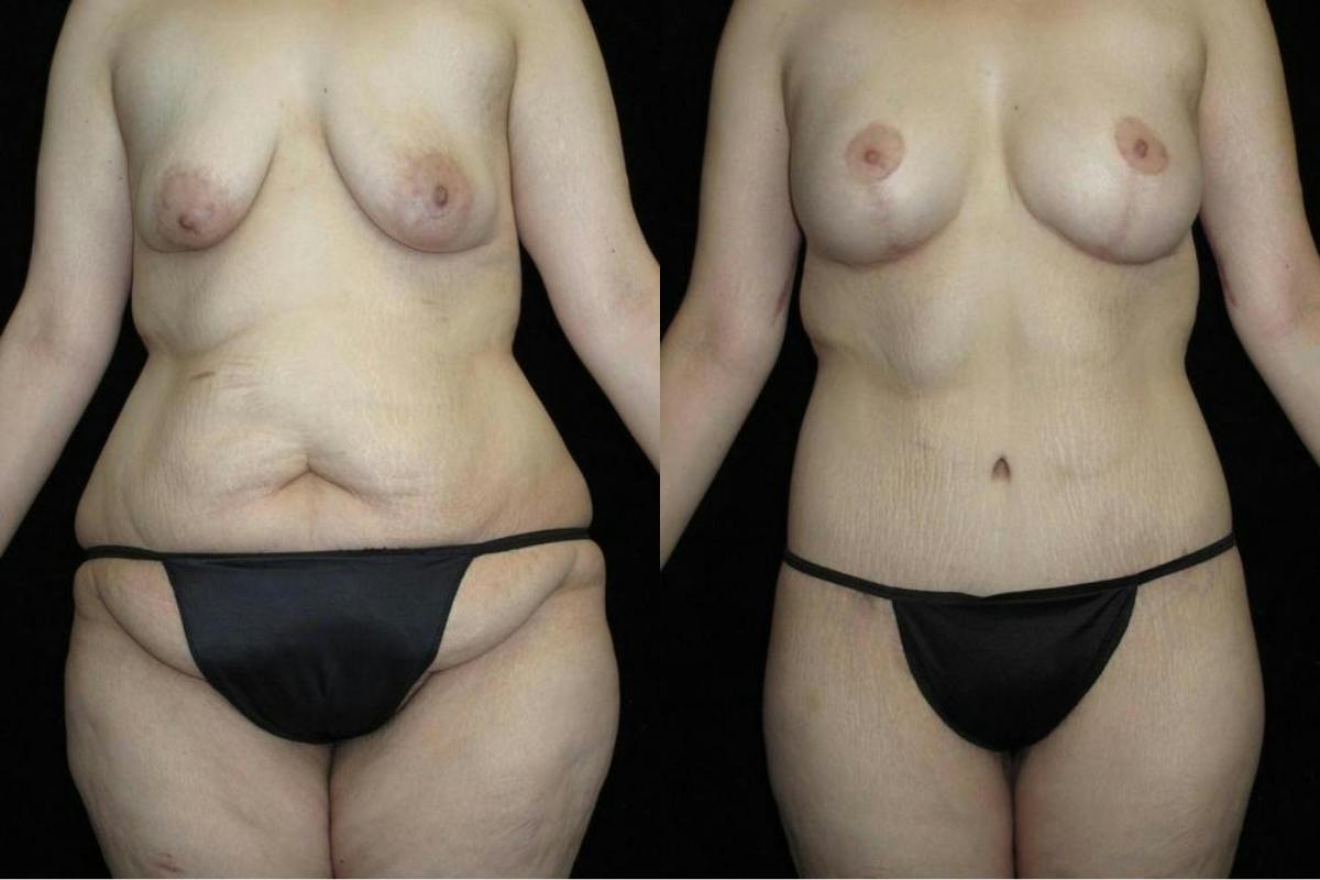 Body Lift Before & After Gallery - Patient 956537 - Image 1