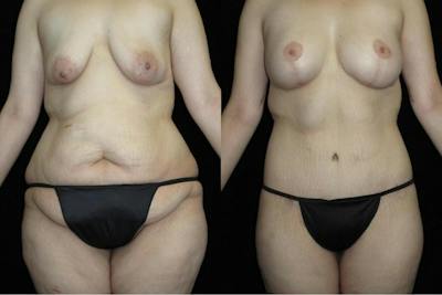 Body Lift Before & After Gallery - Patient 956537 - Image 1