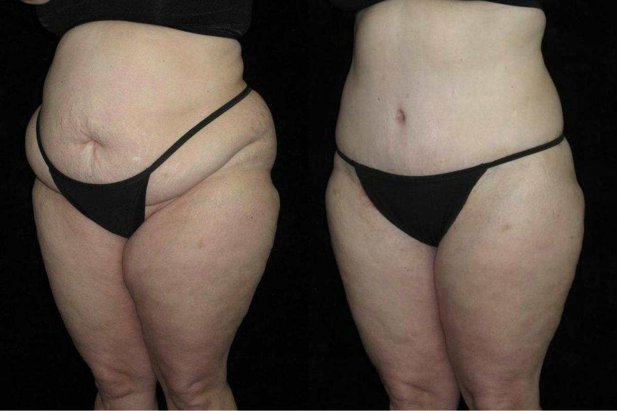 Body Lift Before & After Gallery - Patient 108079 - Image 2