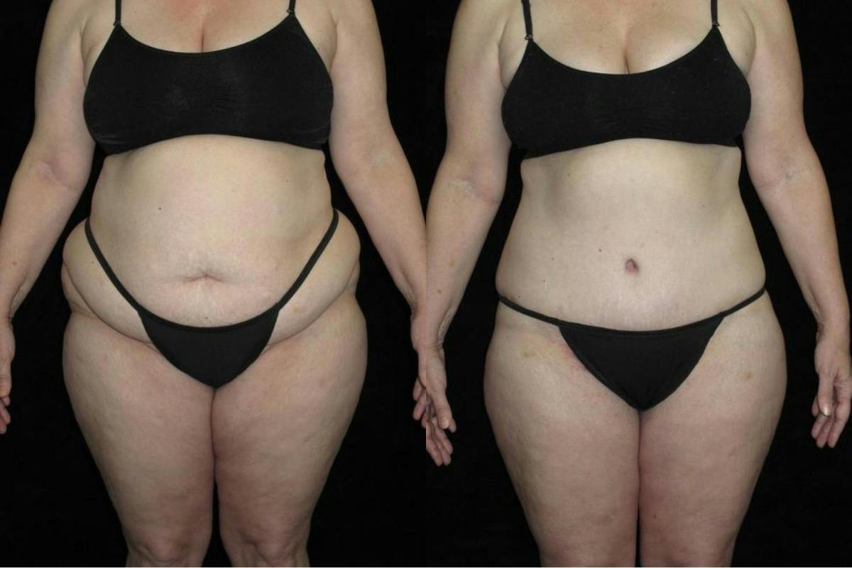 Body Lift Before & After Gallery - Patient 108079 - Image 1