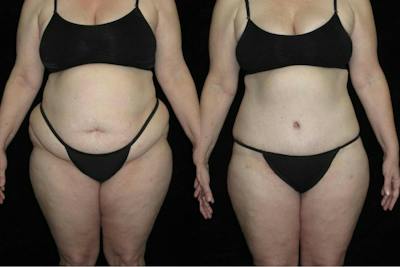 Body Lift Before & After Gallery - Patient 108079 - Image 1