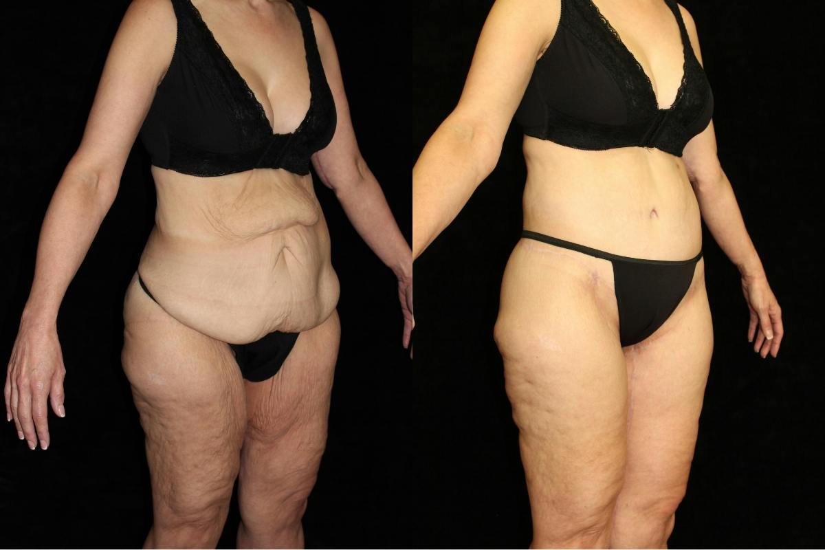 Body Lift Before & After Gallery - Patient 226142 - Image 2
