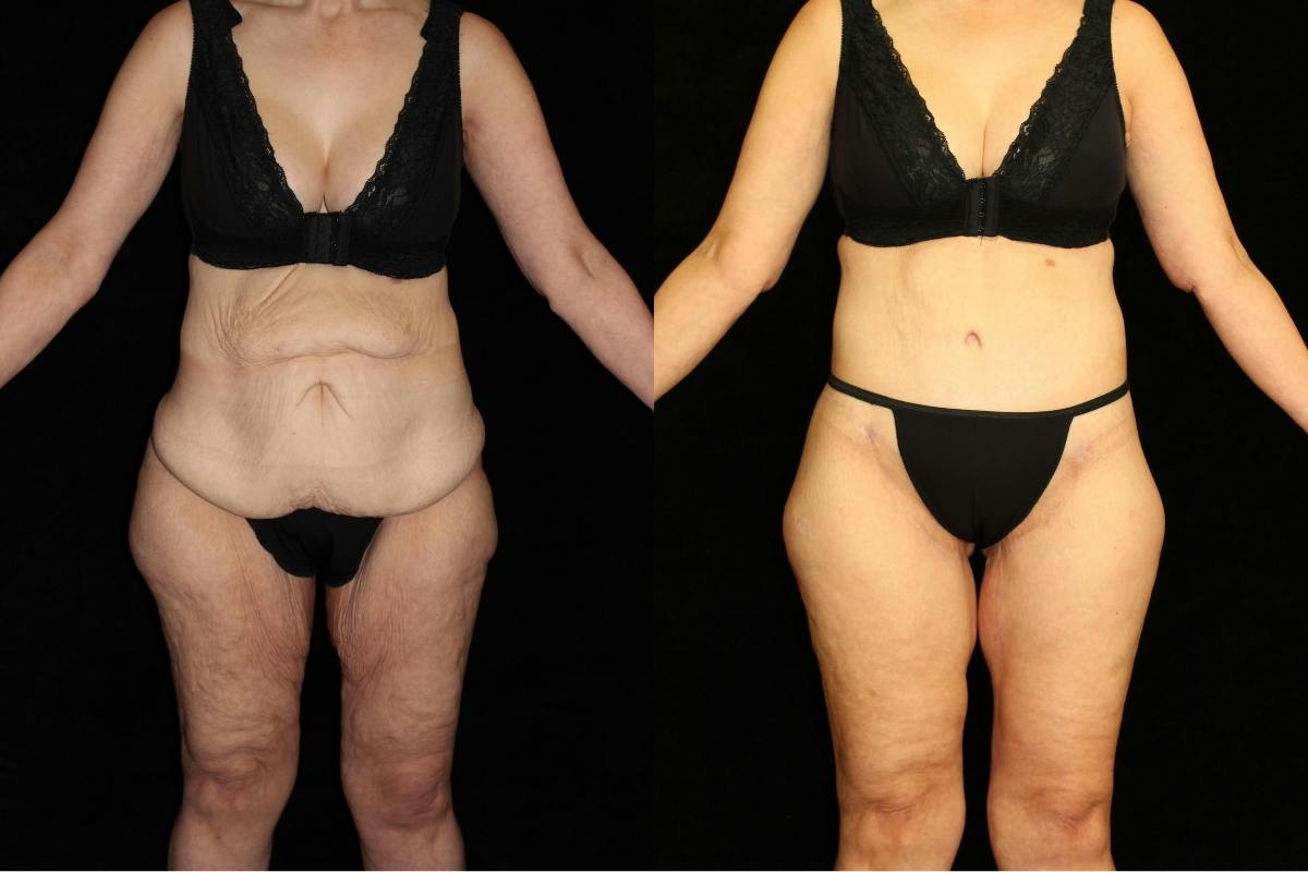 Body Lift Before & After Gallery - Patient 226142 - Image 1
