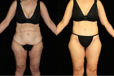 Body Lift Before & After Gallery - Patient 226142 - Image 1
