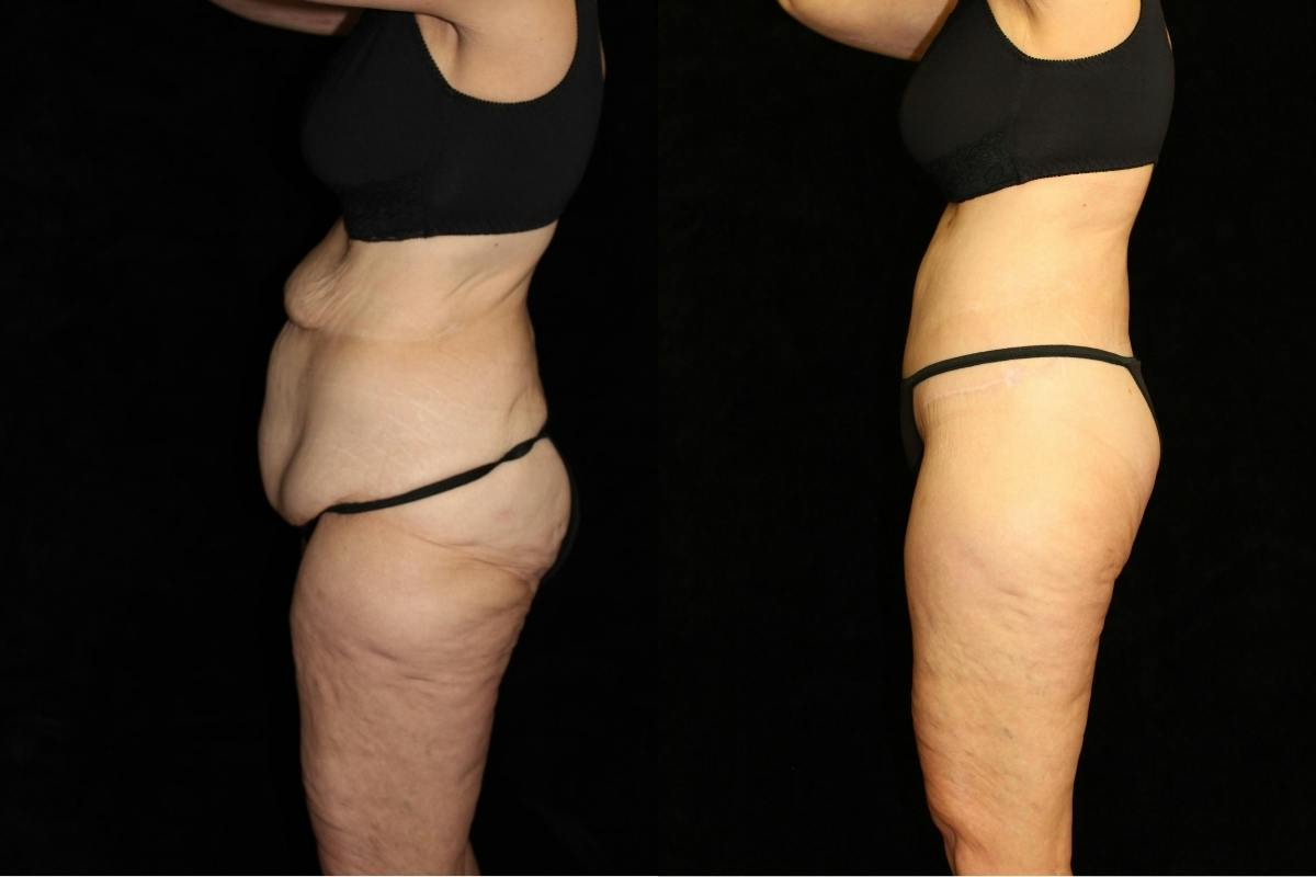 Body Lift Before & After Gallery - Patient 226142 - Image 3