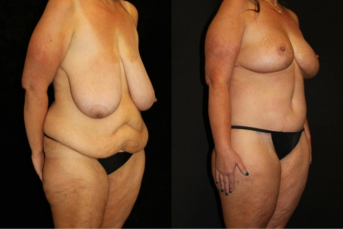 Body Lift Before & After Gallery - Patient 662785 - Image 2