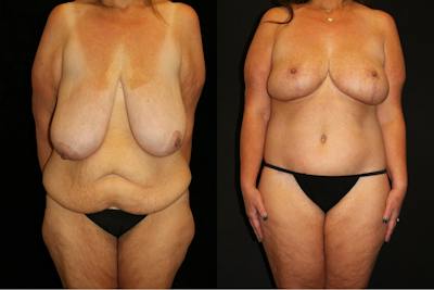 Body Lift Before & After Gallery - Patient 662785 - Image 1