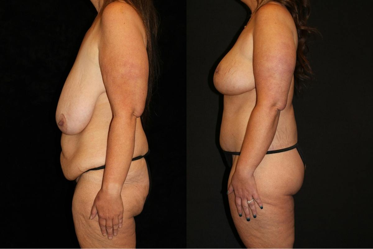 Body Lift Before & After Gallery - Patient 662785 - Image 3