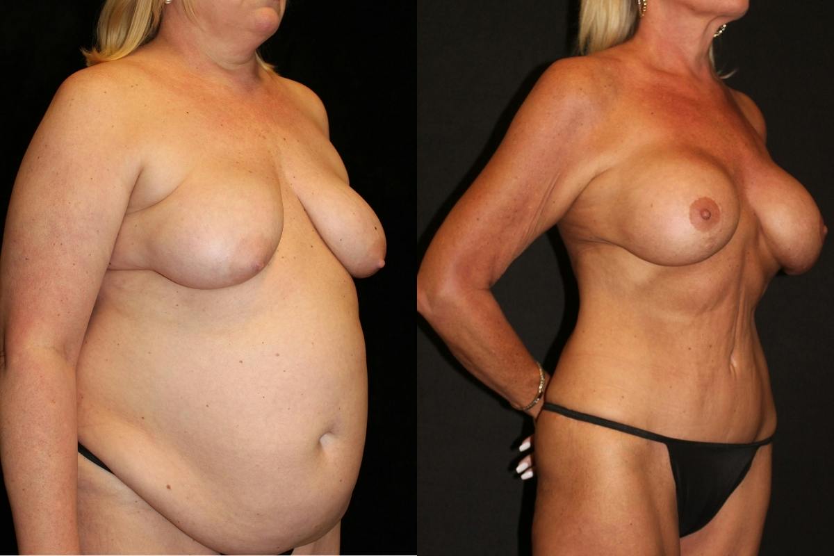 Body Lift Before & After Gallery - Patient 173452 - Image 2